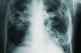 肺有结节需要吃药吗(肺有结节需要吃药吗？如何治疗肺部结节？)